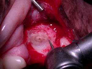 Extracting Animal Tooth Root - Vet Dentistry