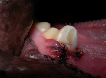 Figure 5. Final appearance after treatment. One composite restoration is clearly visible.