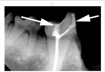 Figure 7. Final radiograph, showing the two composite restorations (arrows) and the filling in the root canal system.