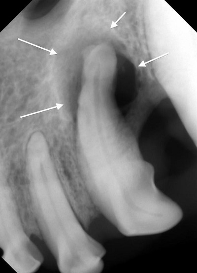 radiograph of canine root resorption