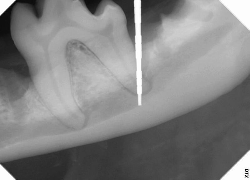 A periodontal probe could be placed to the apex of the distal root of 309, which means that the tooth is likely endodontically infected secondary to bacterial ingress via the apical delta canals. This tooth is a poor candidate for periodontal therapy. The tooth could be treated, however, with a hemi-section, extraction of the distal root and root canal therapy of the mesial root. This treatment would maintain most of the chewing function of the tooth.