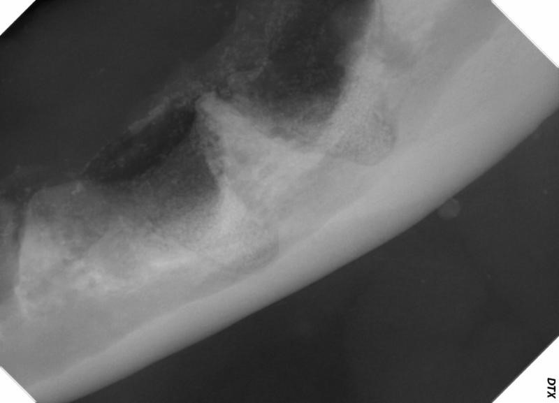 After extraction, a bone graft material (Fusion- Veterinary Transplant Services) was placed in this large defect to help stimulate bone growth. The site was curetted and thoroughly lavaged prior to placement of the graft material.