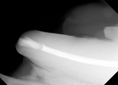 Figure 9.  Final radiograph after crown reduction and root canal therapy of the left lower canine tooth (304). The composite restorations, intermediate restorative layer and root obturation material are all visible. 