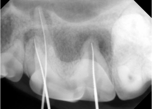 Files placed in root canals of pet tooth